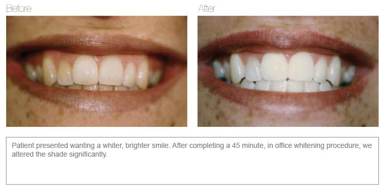 Teeth Whitening Before and After | Dentist Toorak
