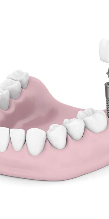 Dental Implants | Simply Smiles Dental - Dentist Toorak