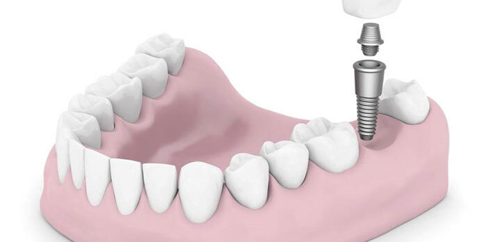 Dental Implants | Simply Smiles Dental - Dentist Toorak