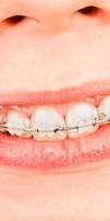 The Benefits of Adult Braces and How They Can Fix Your Smile