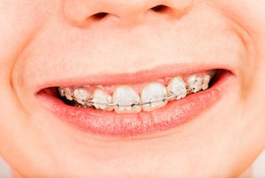 The Benefits of Adult Braces and How They Can Fix Your Smile