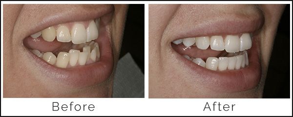 Inman Aligner Before and After | Simply Smiles Dental - Dentist Toorak