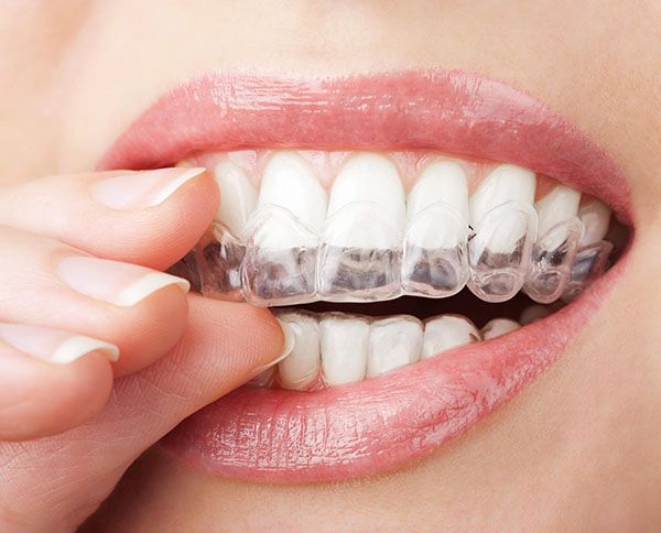 Invisalign | Dentist Toorak