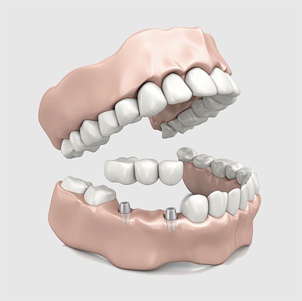 Simply Smiles Dental Dental Bridges | Dentist Toorak