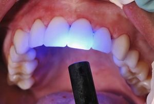 Dental Bonding Toorak | Simply Smiles Dental