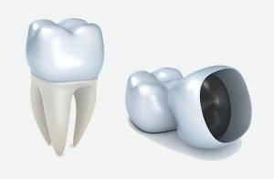 Dental Crowns | Simply Smiles Dental