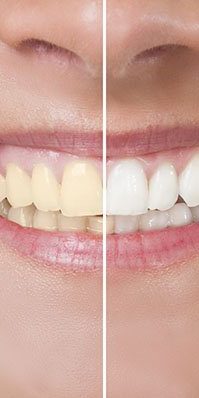 How To Whiten Yellow Teeth Fast